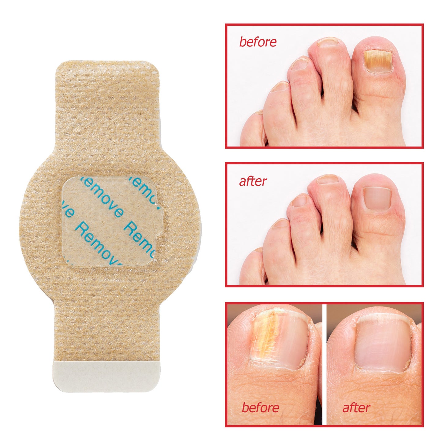 Simpli™ Fungal Nail Patches