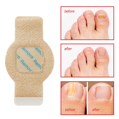 Simpli™ Fungal Nail Patches